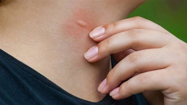 الصحة تكشف حقيقة رصد حالات ملاريا ومتحورات تنفسية جديدة