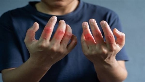 أعراض الروماتويد المبكرة.. التهاب المفاصل أبرزها