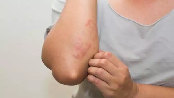 تظهر على الجلد.. اكتشاف علامة غير معروفة لفيروسHMPV