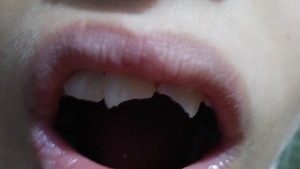 تلميذ يكسر أسنان زميله بمدرسة في القليوبية بسبب تكليف من معلمة