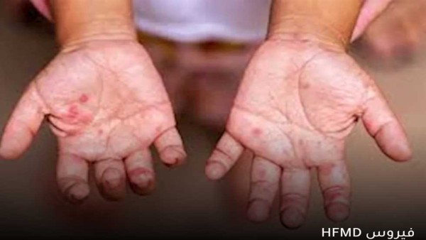 يُعرف بـ7 علامات ويصبح خطيرًا في حالتين.. أسباب ومضاعفات فيروس «HFMD» بعد إصابة 4 طلاب بالجيزة