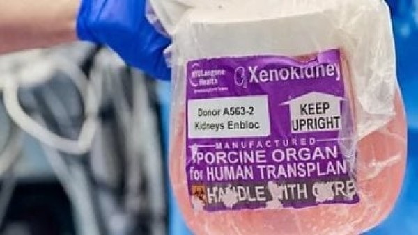 وفاة أول مريض يخضع لزراعة كبد خنزير بعد 171 يوما من إجراء العملية فى الصين