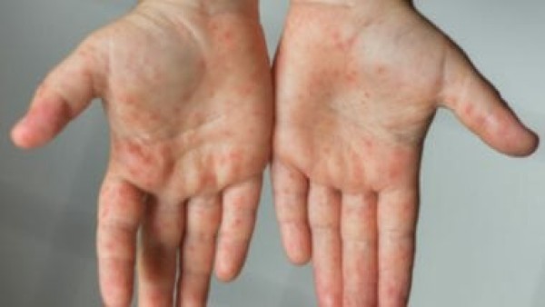 التفاصيل الكاملة لظهور فيروس HFMD بين عدد من طلاب مدرسة فى الجيزة