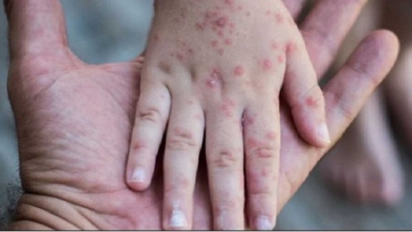 ارتفاع إصابات الجدري المائي في مدرسة بالمنوفية إلى 18 طالبًا