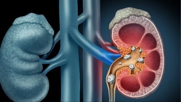 توصلوا إلى مفتاح القتل، "علاج ثوري" قد يُنهي عذاب حصوات الكلى