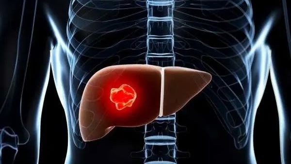 تحذير.. 9 أشياء تجعلك مهددا بسرطان الكبد| وهذه طرق الوقاية