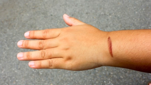 تحذير عاجل من هيئة الدواء بشأن أشهر كريم لعلاج الحروق