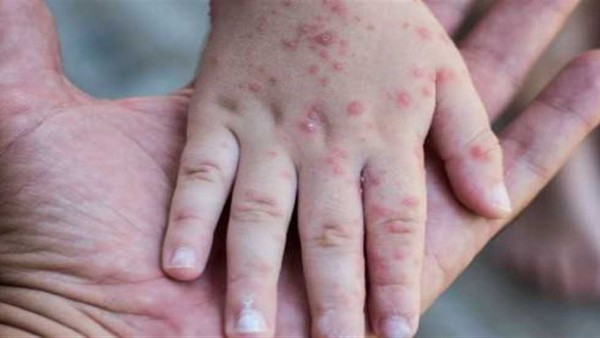 انتشار الجديري المائي في المدارس يقلق أولياء الأمور .. 16 حالة بمدرسة في العمرانية