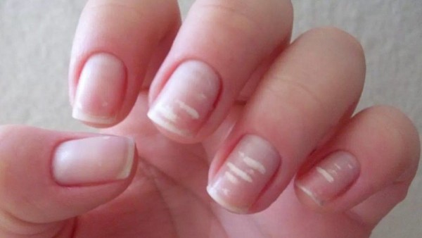 احذر هذه الأطعمة.. 5 علامات تكشف عن نقص الكالسيوم في جسمك