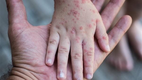 تفشي مرض الحصبة في ولاية أمريكية للمرة الأولى منذ 35 عاما