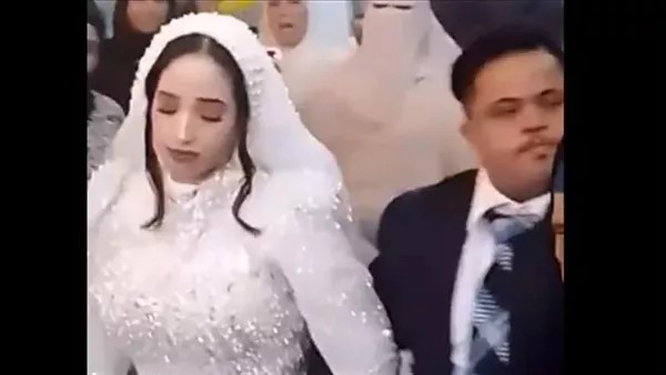 بعد زواج عريس بمتلازمة داون، هل ينتقل المرض بالوراثة وما هي أعراضه؟