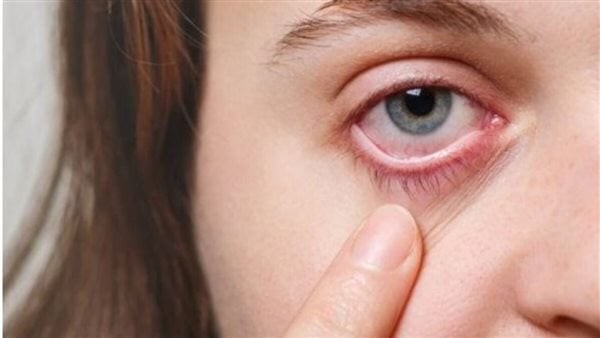 هيئة الدواء: الطقس الحار يسبب الإصابة بحساسية العين والنزلات المعوية