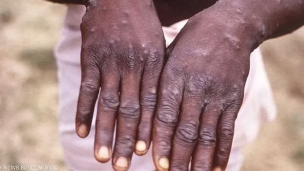 بعد تحذيرات من تفشي الفيروس عالميًا، وفاة أول حالة مصابة بجدري القرود في غانا