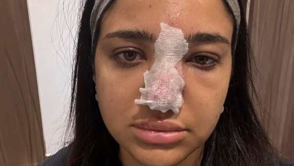 طبيبة تفجر مفاجأة عن فيلر الأنف بعد أزمة كنزي مدبولي