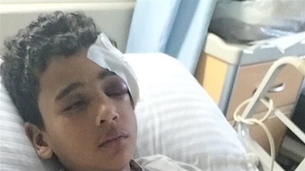 إصابة صغير بكسر في الجمجمة وتهتك بالفك إثر رشقه بالحجارة خلال ركوبه قطارًا بالمنوفية |فيديو