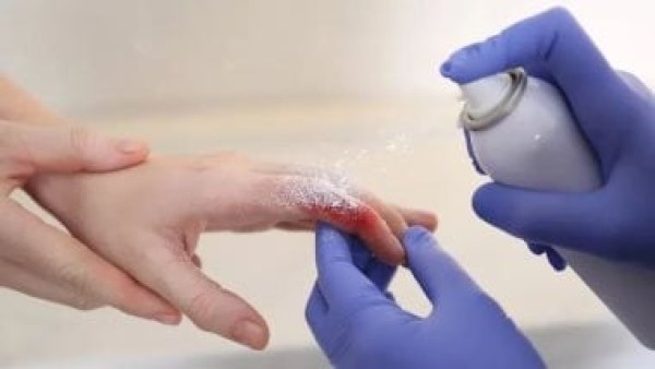 علماء يبتكرون مسحوق بخاخ للطوارئ يوقف النزيف الحاد خلال ثانية واحدة